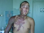 Военные следователи Уссурийска начали проверку ЧП, произошедшего с рядовым, который получил сильные ожоги лица и тела